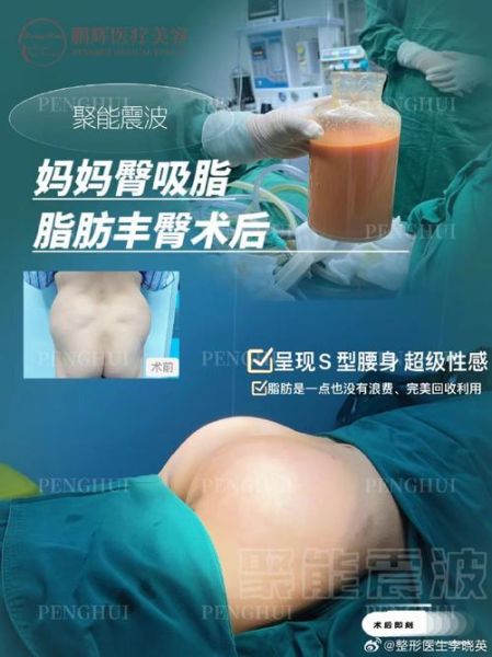 臀部吸脂减肥的价格:臀部吸脂减肥多少钱
